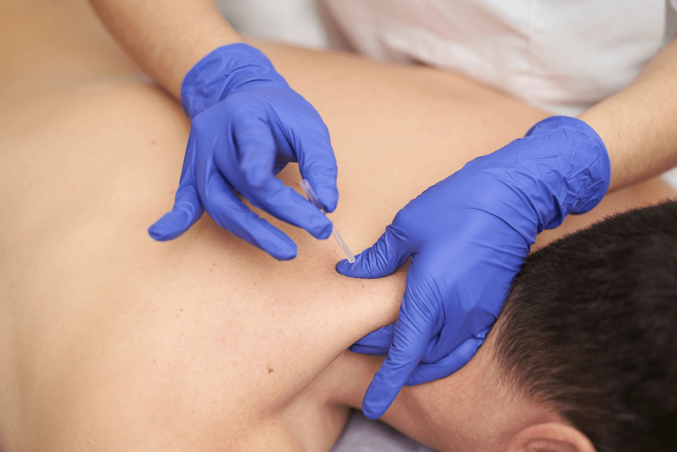 Puncture sèche (dry needling) — Physio Activa